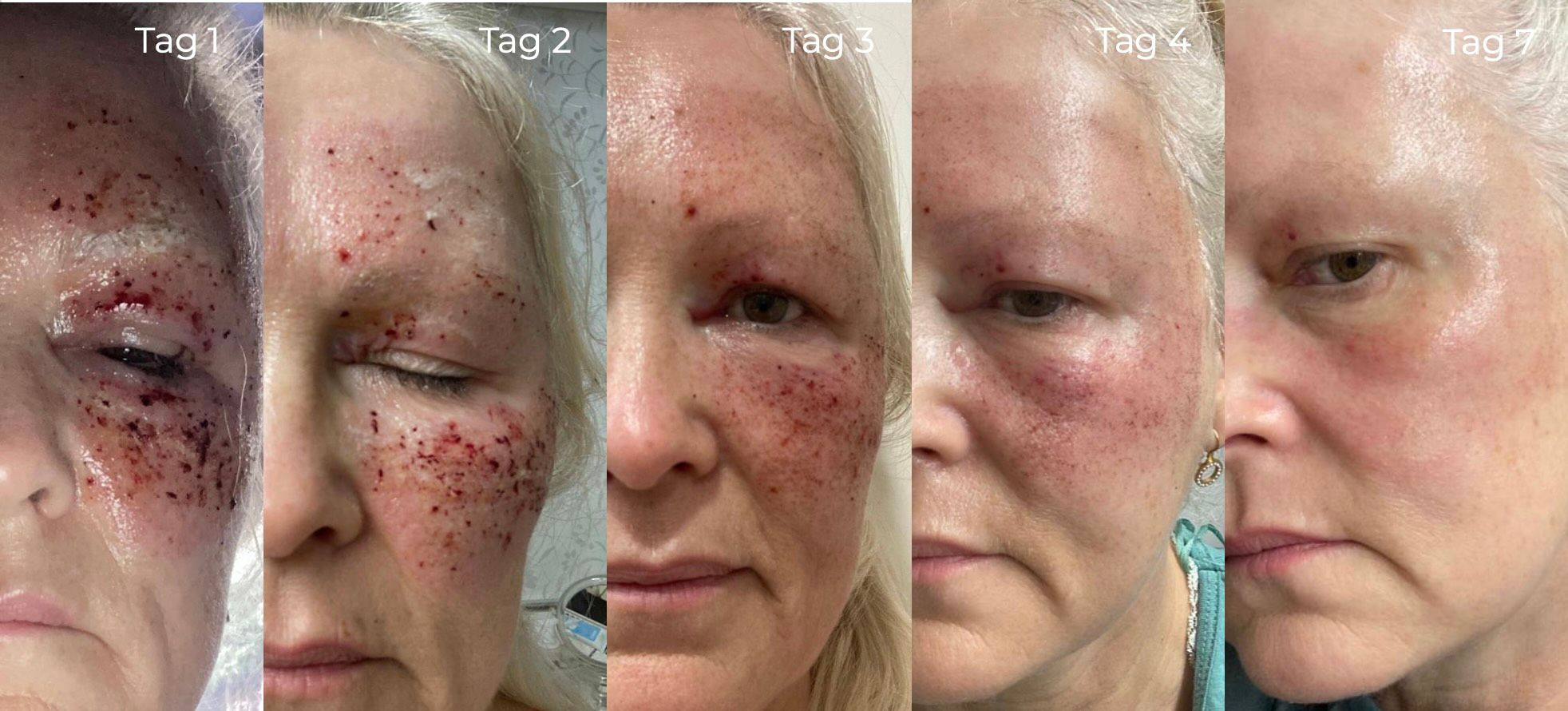 Wundheilung nach CO2-Laser-Lidstraffung